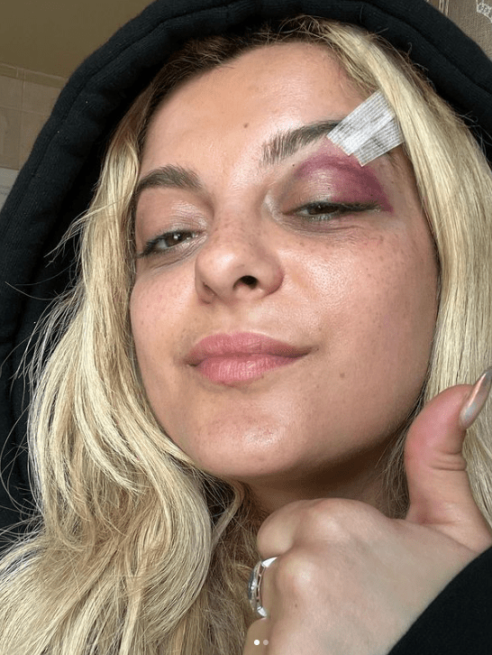 Bebe Rexha recibe golpe con un celular