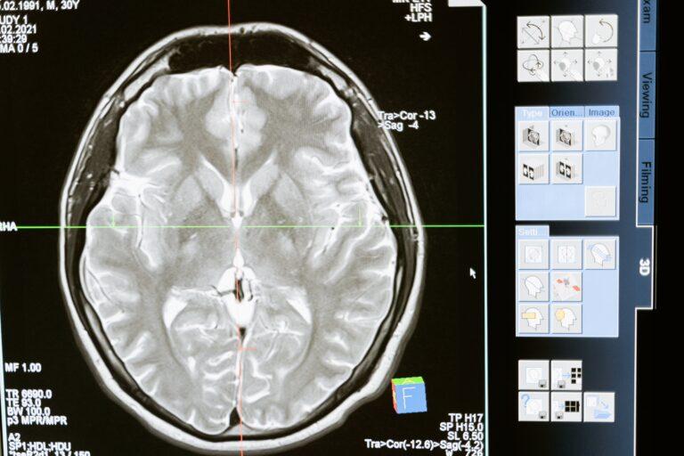 Implante cerebral puede mejorar algunas funciones cognitivas Implante cerebral puede mejorar algunas funciones cognitivas