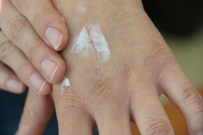 Advierten sobre cáncer de piel por rayos ultravioleta